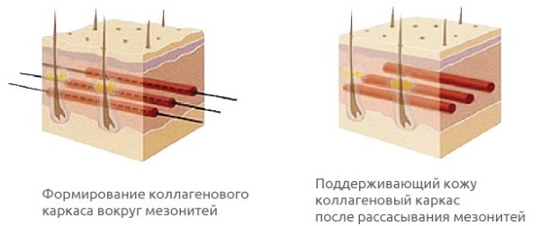 Threadlifting with 3D mesothreads for face, lips, forehead, abdomen. Before and after photos, reviews, price of the procedure