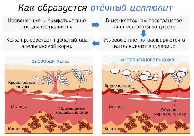 Cellulite su gambe e glutei. Come sbarazzarsi: esercizio, dieta, impacchi, massaggi, maschere, scrub