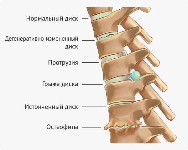 Yoga per schiena e colonna vertebrale: caratteristiche, indicazioni e controindicazioni, una serie di semplici esercizi, le migliori asana. Video per principianti