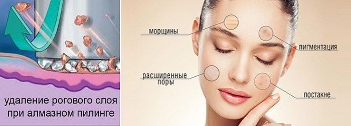 Diamond microdermabrasion of the face - what is it, devices, creams for enzymatic micropeeling. Procedure price