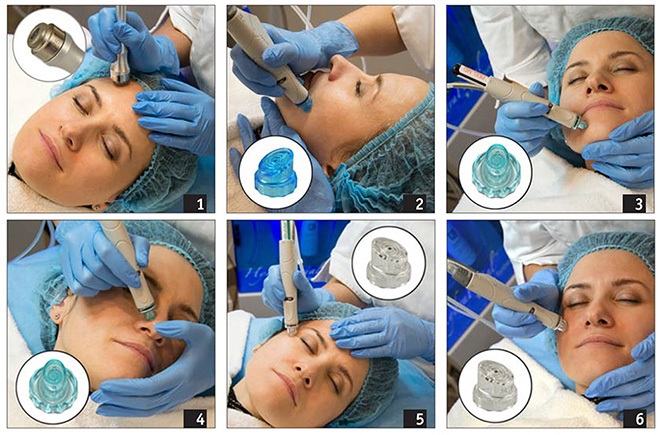 Diamond microdermabrasion of the face - what is it, devices, creams for enzymatic micropeeling. Procedure price