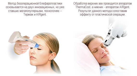 Non-surgical blepharoplasty of the upper and lower eyelids: circular, laser, hardware. Prices, rehabilitation and possible complications