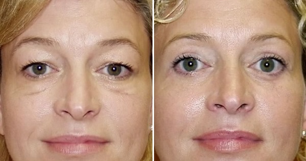 Non-surgical blepharoplasty of the upper and lower eyelids: circular, laser, hardware. Prices, rehabilitation and possible complications