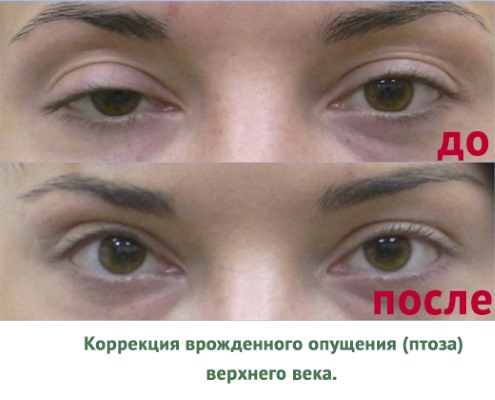 Non-surgical blepharoplasty of the upper and lower eyelids: circular, laser, hardware. Prices, rehabilitation and possible complications