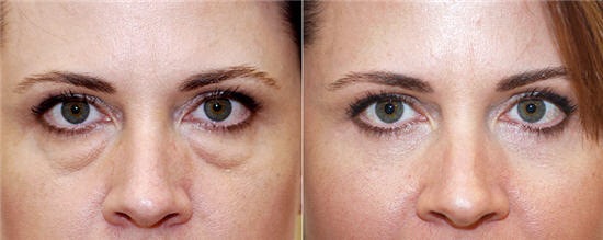 Non-surgical blepharoplasty of the upper and lower eyelids: circular, laser, hardware. Prices, rehabilitation and possible complications