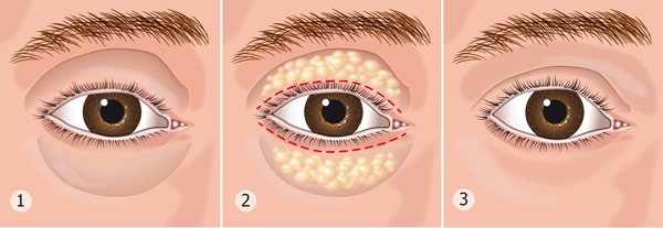 Non-surgical blepharoplasty of the upper and lower eyelids: circular, laser, hardware. Prices, rehabilitation and possible complications