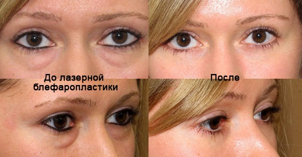 Non-surgical blepharoplasty of the upper and lower eyelids: circular, laser, hardware. Prices, rehabilitation and possible complications