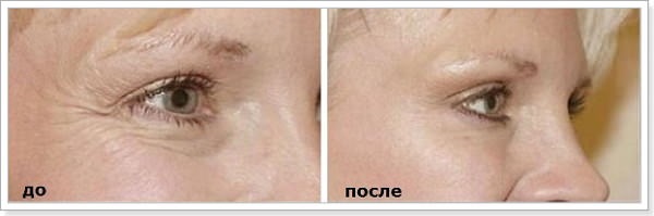 Non-surgical blepharoplasty of the upper and lower eyelids: circular, laser, hardware. Prices, rehabilitation and possible complications