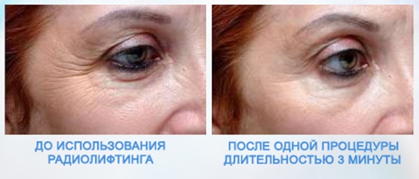 Non-surgical blepharoplasty of the upper and lower eyelids: circular, laser, hardware. Prices, rehabilitation and possible complications