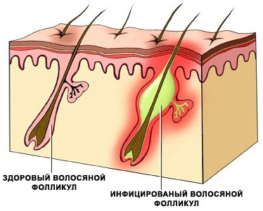 Boost up for hair. Before and after photos, how Bust up the root volume is done, the consequences of the procedure