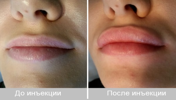 Fillers in the nasolabial folds, under the eyes, in the lips, in the cheekbones. Correction of the nose, nasolacrimal groove. Facial contouring