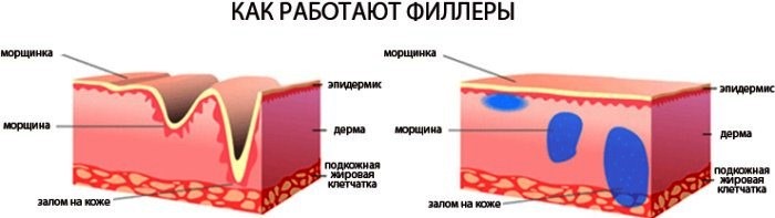 Fillers in the nasolabial folds, under the eyes, in the lips, in the cheekbones. Correction of the nose, nasolacrimal groove. Facial contouring