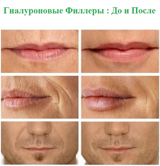 Fillers in the nasolabial folds, under the eyes, in the lips, in the cheekbones. Correction of the nose, nasolacrimal groove. Facial contouring