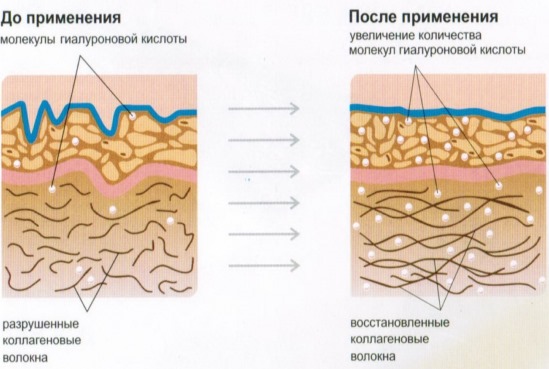 Fillers in the nasolabial folds, under the eyes, in the lips, in the cheekbones. Correction of the nose, nasolacrimal groove. Facial contouring