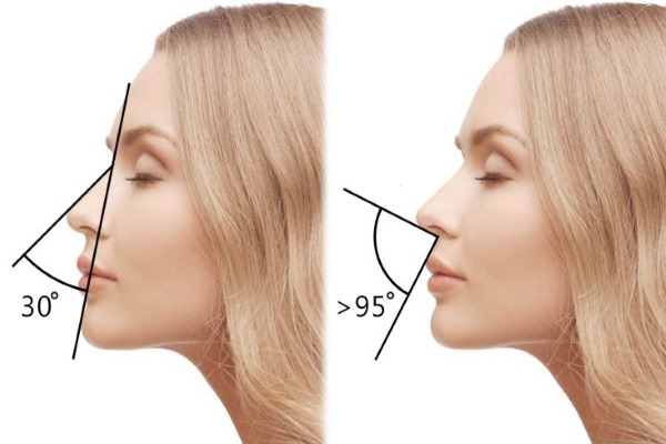 Fillers in the nasolabial folds, under the eyes, in the lips, in the cheekbones. Correction of the nose, nasolacrimal groove. Facial contouring