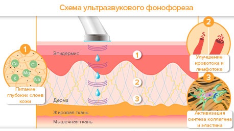 Phonophoresis of the face with hydrocortisone, caripain, hyaluronic acid. Indications and contraindications, devices for ultrasound procedures