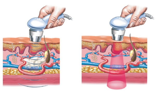 Phonophoresis of the face with hydrocortisone, caripain, hyaluronic acid. Indications and contraindications, devices for ultrasound procedures