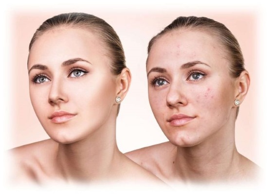 Gas-liquid face peeling. What is it, indications, contraindications. Application for pregnancy, acne, rosacea. Before and after photos, reviews