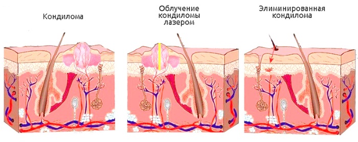 How to get rid of papillomas on the body using folk remedies, medications, surgical methods