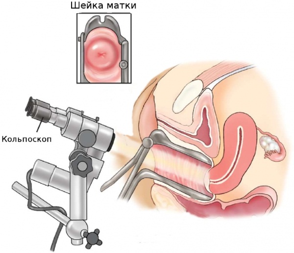 How to get rid of papillomas on the body using folk remedies, medications, surgical methods