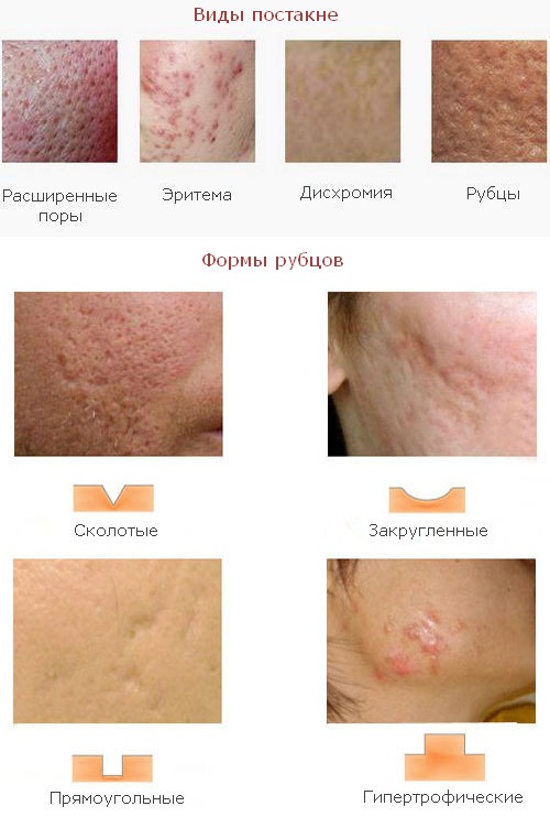 How to get rid of acne scars at home. Ointments, creams, folk remedies