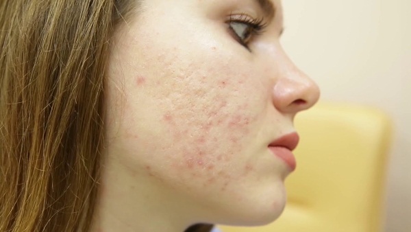 How to get rid of acne scars at home. Ointments, creams, folk remedies