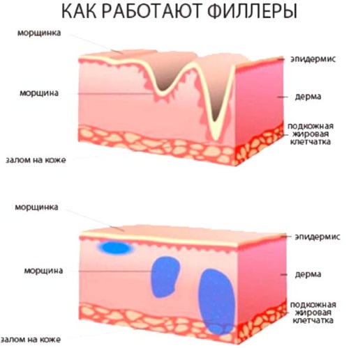 How to get rid of acne scars at home. Ointments, creams, folk remedies