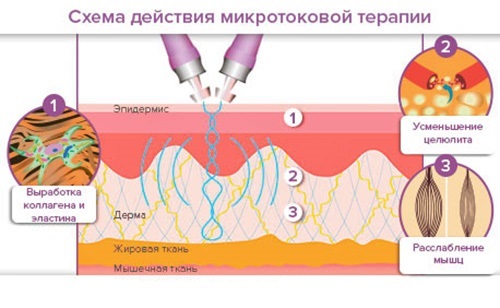 How to remove wrinkles on the forehead, under the eyes, nasolabial, above the upper lip, between the eyebrows, on the neck, between the eyebrows, mimic