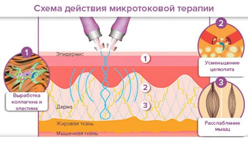 Face lifting: what is it, SMAS, RF, plasma, massage, ultrasonic, filament, endoscopic, radio wave, vector, radio frequency, laser, acupuncture