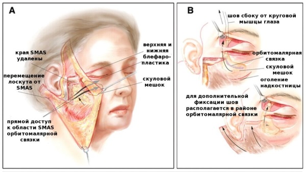 Face lifting: what is it, SMAS, RF, plasma, massage, ultrasonic, filament, endoscopic, radio wave, vector, radio frequency, laser, acupuncture