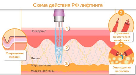 Face lifting: what is it, SMAS, RF, plasma, massage, ultrasonic, filament, endoscopic, radio wave, vector, radio frequency, laser, acupuncture