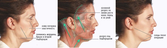 Face lifting: what is it, SMAS, RF, plasma, massage, ultrasonic, filament, endoscopic, radio wave, vector, radio frequency, laser, acupuncture