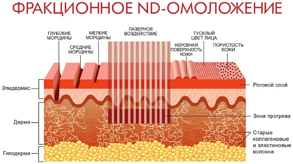 Face lifting: what is it, SMAS, RF, plasma, massage, ultrasonic, filament, endoscopic, radio wave, vector, radio frequency, laser, acupuncture