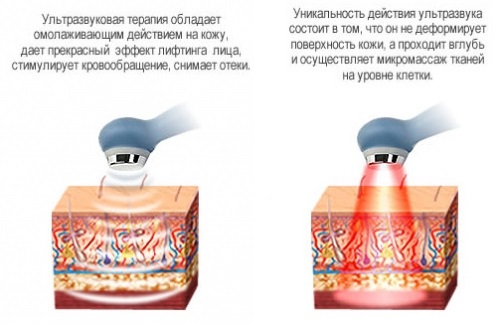 Face lifting: what is it, SMAS, RF, plasma, massage, ultrasonic, filament, endoscopic, radio wave, vector, radio frequency, laser, acupuncture