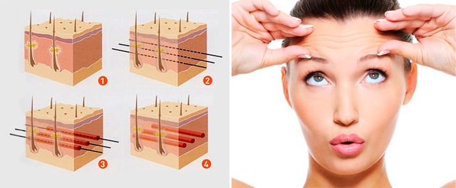 Face lifting: what is it, SMAS, RF, plasma, massage, ultrasonic, filament, endoscopic, radio wave, vector, radio frequency, laser, acupuncture