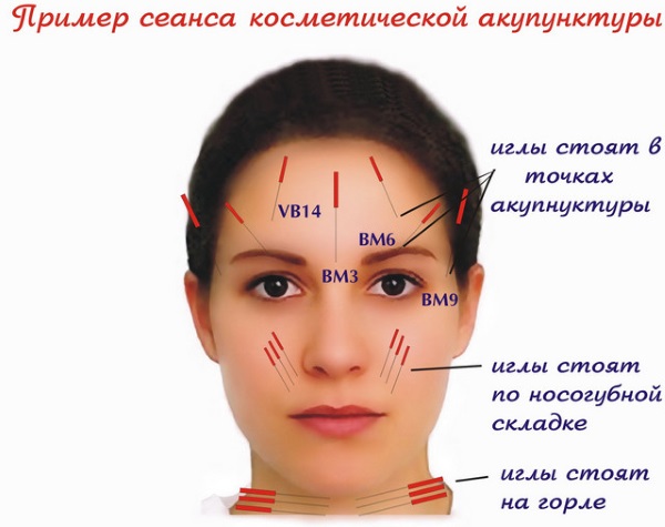 Face lifting: what is it, SMAS, RF, plasma, massage, ultrasonic, filament, endoscopic, radio wave, vector, radio frequency, laser, acupuncture