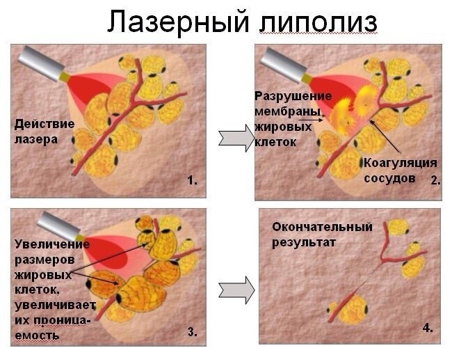 Lipolytika für Gesicht, Kinn, Nase. Anwendungsergebnisse, Preise, Nebenwirkungen von Mesotherapie-Injektionen