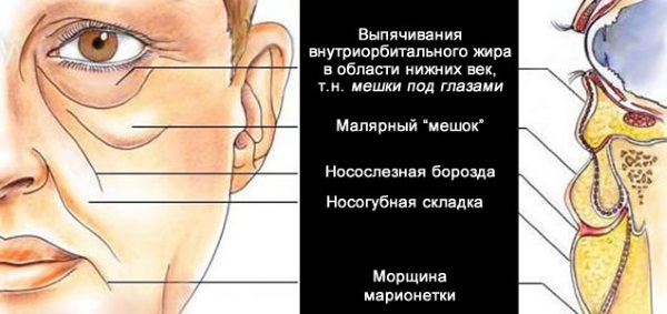 Lipolytika für Gesicht, Kinn, Nase. Anwendungsergebnisse, Preise, Nebenwirkungen von Mesotherapie-Injektionen