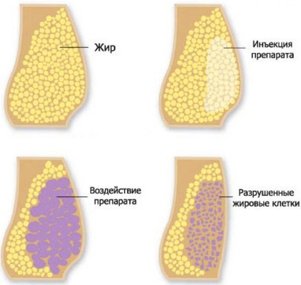 Lipolytika für Gesicht, Kinn, Nase. Anwendungsergebnisse, Preise, Nebenwirkungen von Mesotherapie-Injektionen