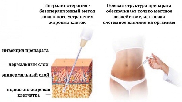 Lipolytika für Gesicht, Kinn, Nase. Anwendungsergebnisse, Preise, Nebenwirkungen von Mesotherapie-Injektionen