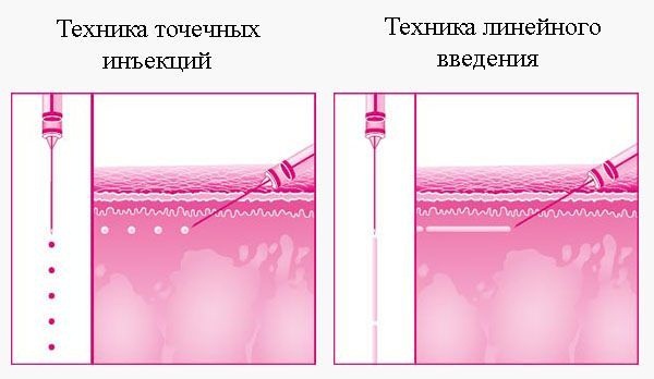 Mesoxantina nelle procedure di biorivitalizzazione. Efficienza dell'applicazione, recensioni di cosmetologi, istruzioni su come pungere. Prezzo della droga