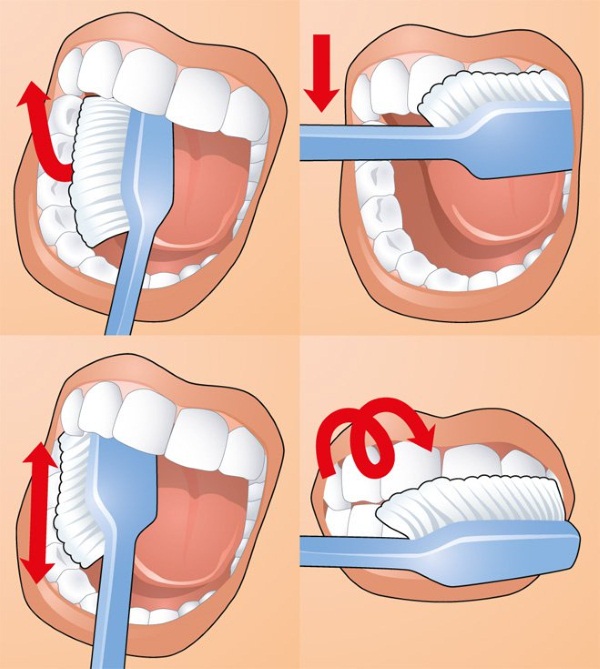 Operation to remove Bish's lumps. How it goes, the price, the consequences in old age