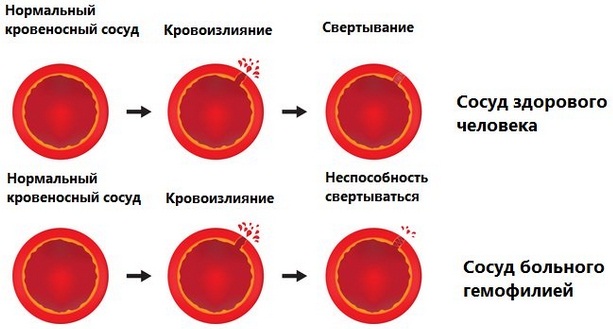 Operation to remove Bish's lumps. How it goes, the price, the consequences in old age