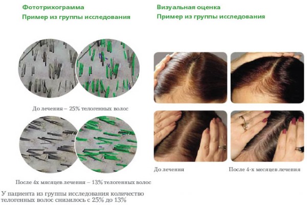 Pantovigar. Instructions for use, composition, how to take vitamins against hair loss, for hair growth. Analogs