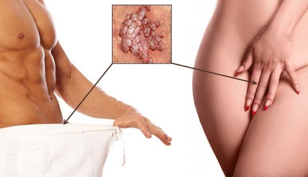 How to get rid of papillomas on the body using folk remedies, medications, surgical methods