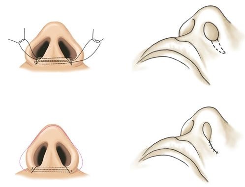 Plastic surgery on the nose. Types, prices: correction of the septum, reduction of the nose, remove the hump, reshape, contour rhinoplasty