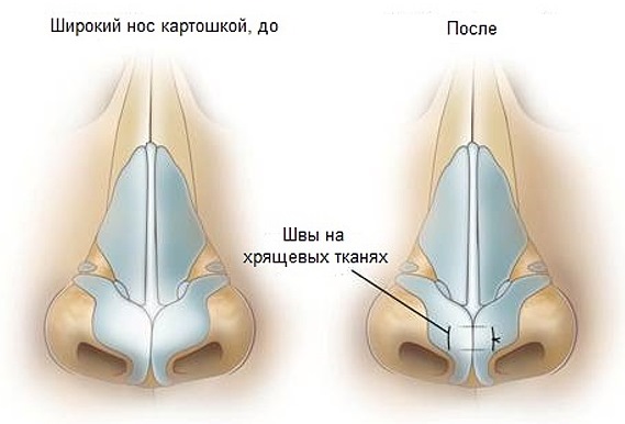 Plastic surgery on the nose. Types, prices: correction of the septum, reduction of the nose, remove the hump, reshape, contour rhinoplasty