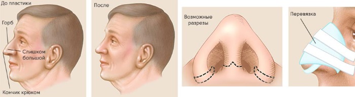 Plastic surgery on the nose. Types, prices: correction of the septum, reduction of the nose, remove the hump, reshape, contour rhinoplasty