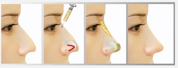 Chirurgia plastica sul naso. Tipi, prezzi: correzione del setto, riduzione del naso, rimozione della gobba, rimodellamento, rinoplastica del contorno