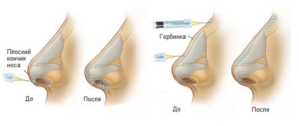 Chirurgia plastica sul naso. Tipi, prezzi: correzione del setto, riduzione del naso, rimozione della gobba, rimodellamento, rinoplastica del contorno